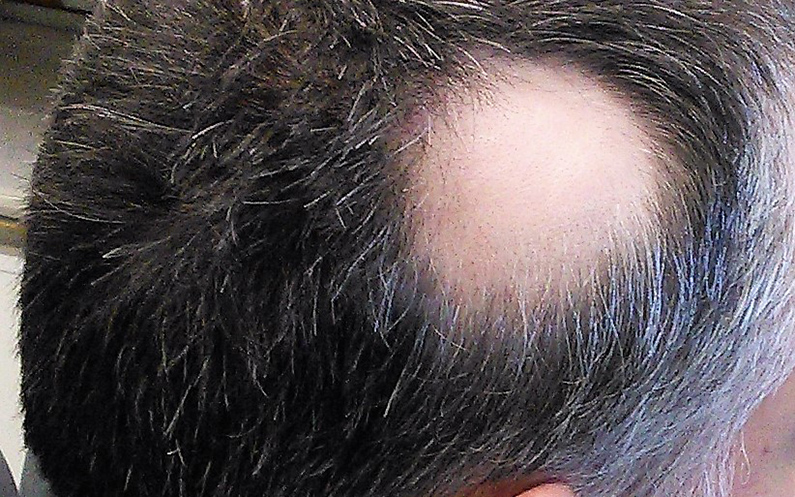pierna Fuera contenido 7 claves para saber qué es la alopecia areata - Rueber Centro Capilar