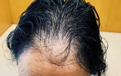 Alopecia androgenética femenina: causas y soluciones