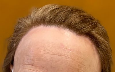 ¿Qué es la alopecia frontal fibrosante? Conoce nuestro caso de éxito