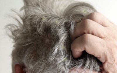 Dermatitis seborreica en el cuero cabelludo, causas y cuidado
