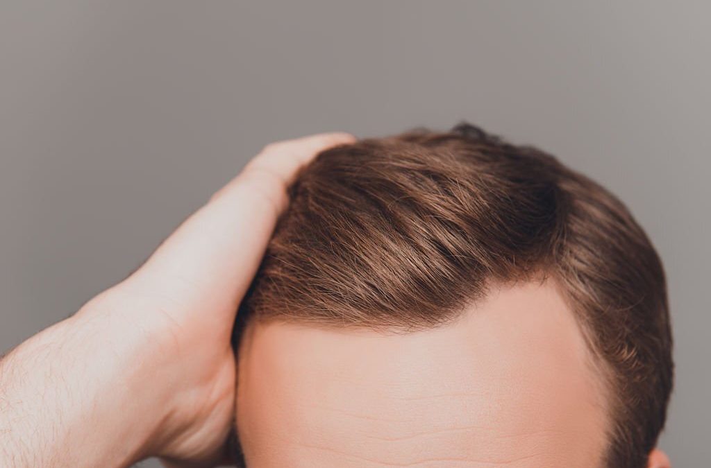 Cuidar el cabello después e un trasplante capilar