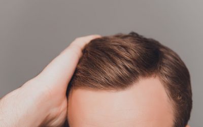 Cuidar el cabello después e un trasplante capilar