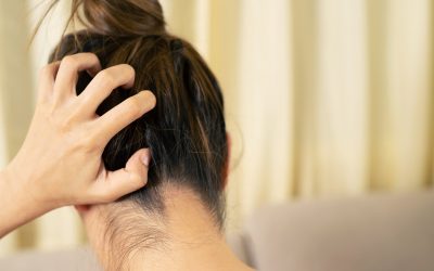 ¿Cómo aliviar los síntomas de la psoriasis en el cuero cabelludo?