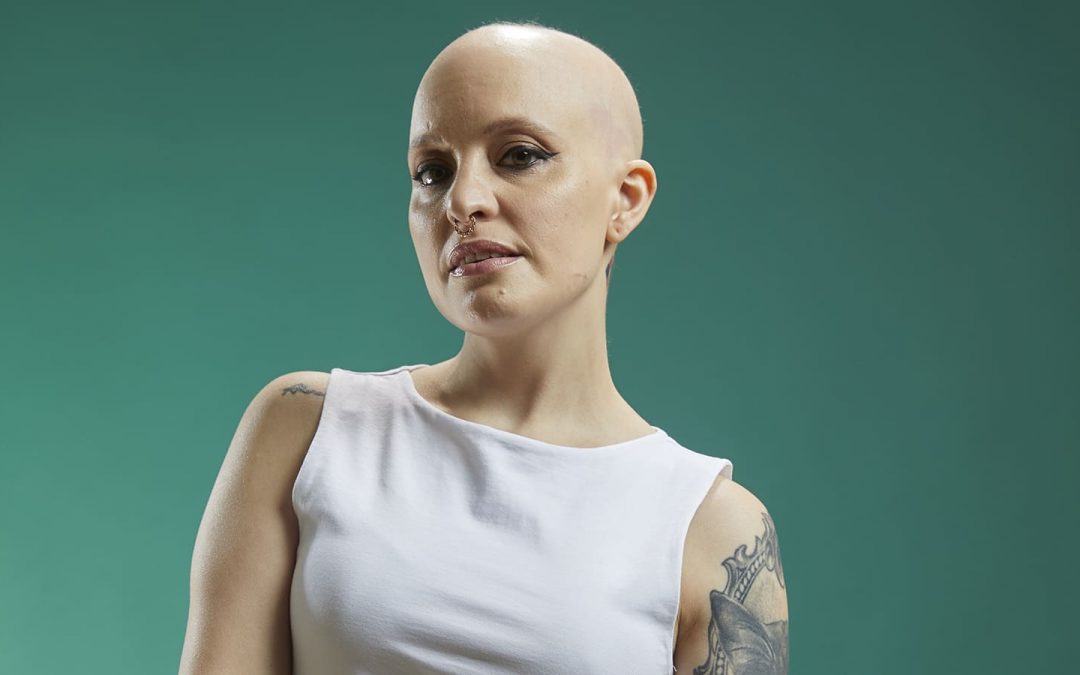 ¿Qué es la alopecia areata?