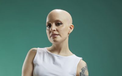 Alopecia Areata Universal: recuperar la imagen y la confianza con prótesis capilares personalizadas